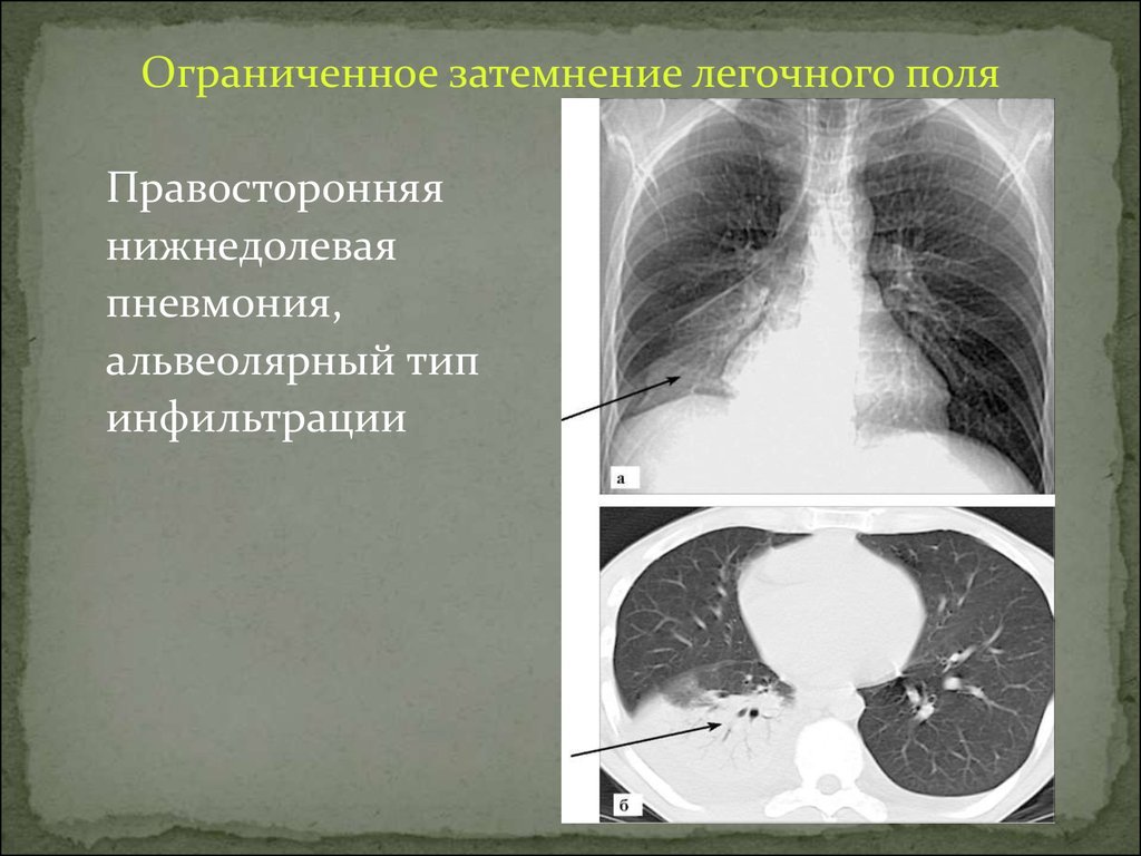 Поля легких. Синдром ограниченного затемнения легочной ткани. Альвиолярная инфильтрация СКТ. Ограниченное затемнение рентген легких. Ограниченное затемнение легочного поля.