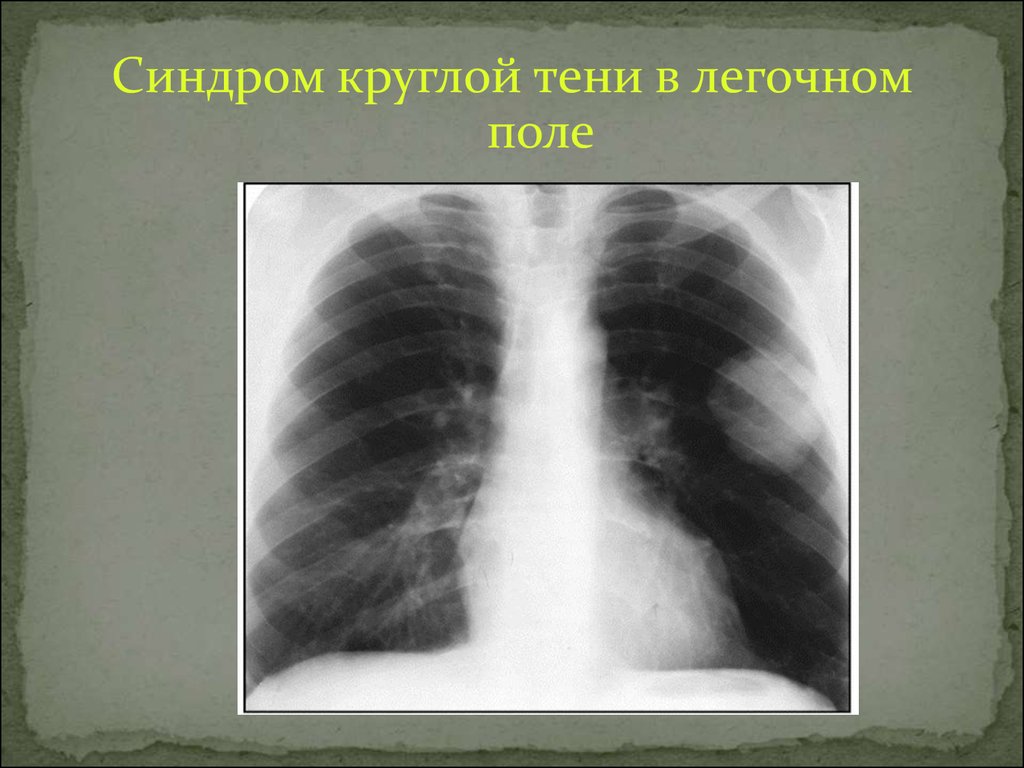 Тень в легких. Синдром кольцевидной тени патологии легочной ткани. Кольцевидные тени в легких на рентгене. Кольцевидная тень рентген. Синдром обширного затемнения легочного поля.