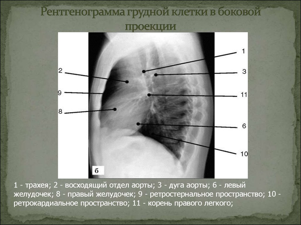 Рентгенография в двух проекциях. Левая боковая проекция грудной клетки рентген. Рентген грудной клетки в боковой проекции норма. Рентгеноанатомия органов грудной клетки в боковой проекции. Рентгенограмма грудной клетки в боковой проекции.