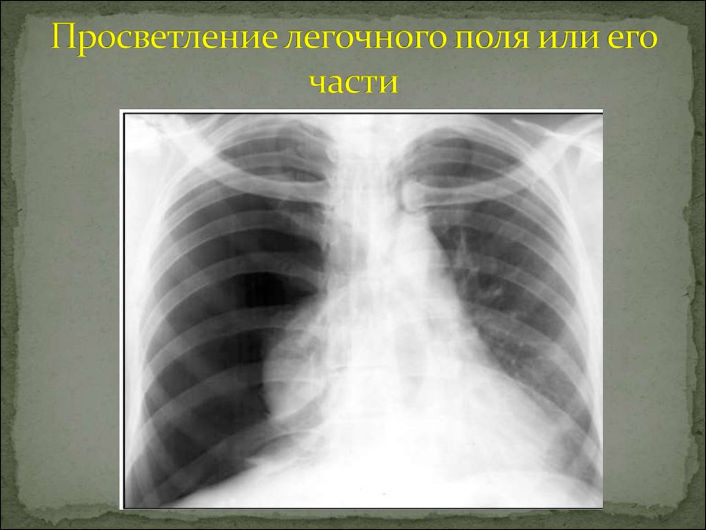 Поля легких. Синдром ограниченного затемнения рентген. Синдром обширного просветления легочного поля. Просветление легочного поля рентген. Обширное просветление легочного поля рентген.