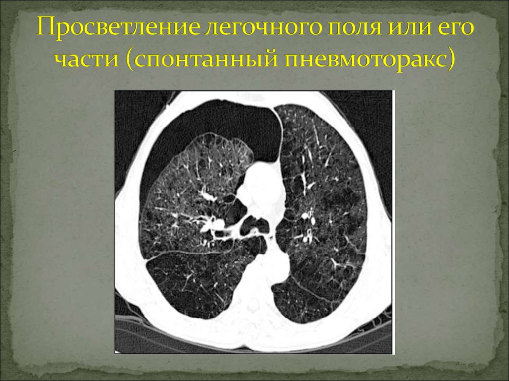 Поля легких. Просветление легочного поля или его части. Обширное просветление легочного поля. Синдром просветления легочного поля. Синдром просветление легочного поля или его части.