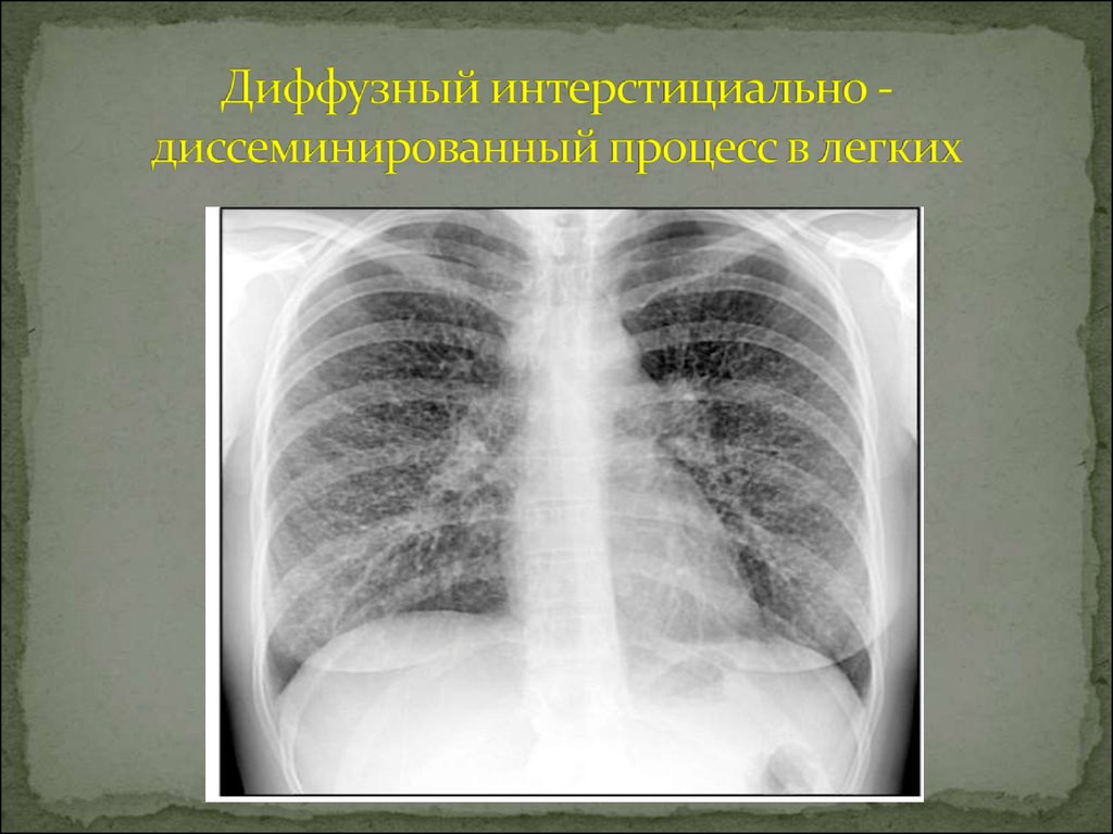 Диффузные изменения в легких. Очаговая диссеминация легких рентген. Ограниченная диссеминация легких рентген. Диссеминированный процесс в легких рентген. Интерстициальные заболевания легких рентген.