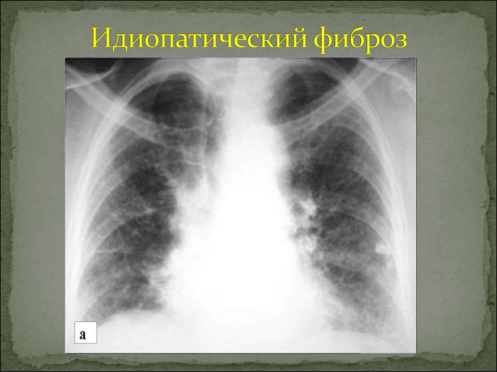 Какая рентгенологическая картина характерна для легочного фиброза