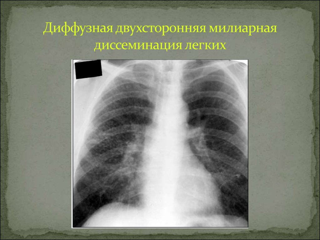 Двухсторонняя диффузная. Синдром диффузной диссеминации рентген. Синдром диссеминированного поражения легких. Диссеминированный туберкулез рентген синдром. Синдром легочной диссеминации рентген.