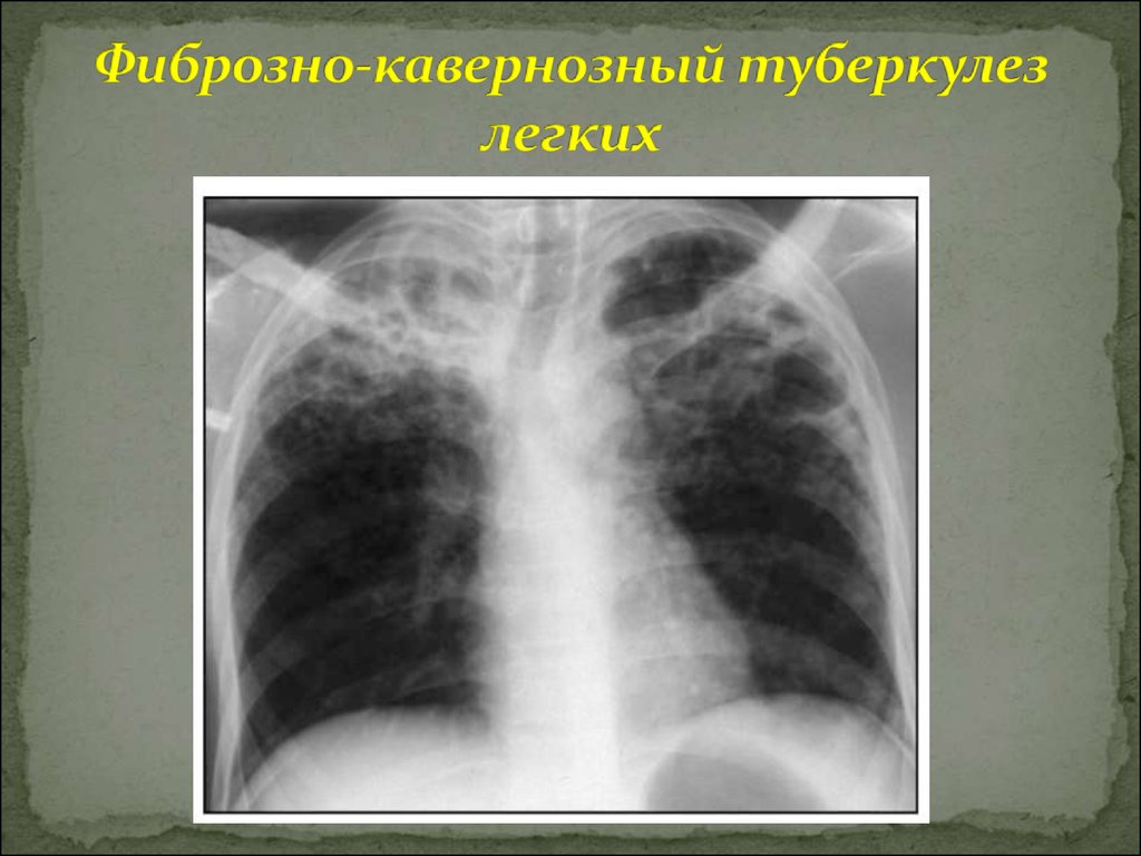 Фиброзно легкого. Диссеминированный кавернозный туберкулез. Фиброзно-кавернозный туберкулез рентген. Кольцевидная тень кавернозный туберкулез. Кавернозный туберкулез рентген.