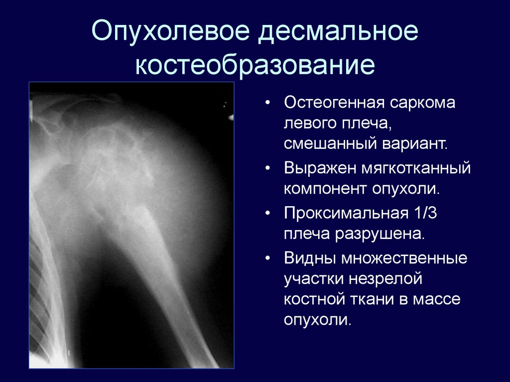 Диагноз саркома. Саркома плечевого сустава рентген. Остеосаркома плечевого сустава рентген. Остеогенная саркома бедренной кости рентген. Остеосаркома плечевой кости кт.