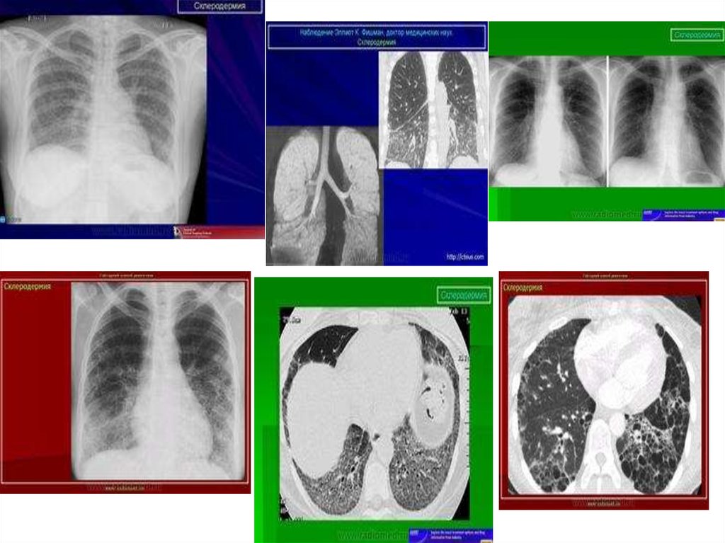 Диффузная системная склеродермия. Системная склеродермия. Поражение легких при склеродермии. Очаговая склеродермия клинические рекомендации. Системная склеродермия диффузная форма.