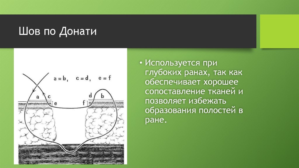 Жидкость шов. Шов Мак-Миллана –Донати. Вертикальный матрацный шов Донати. П образный шов по Донати.