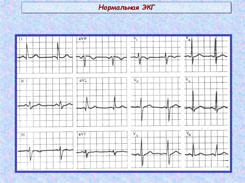 Как выглядит экг. Норма ЭКГ во всех отведениях. ЭКГ здорового человека в 12 отведениях. ЭКГ снимок норма. Нормальная ЭКГ 12 отведений рисунок.