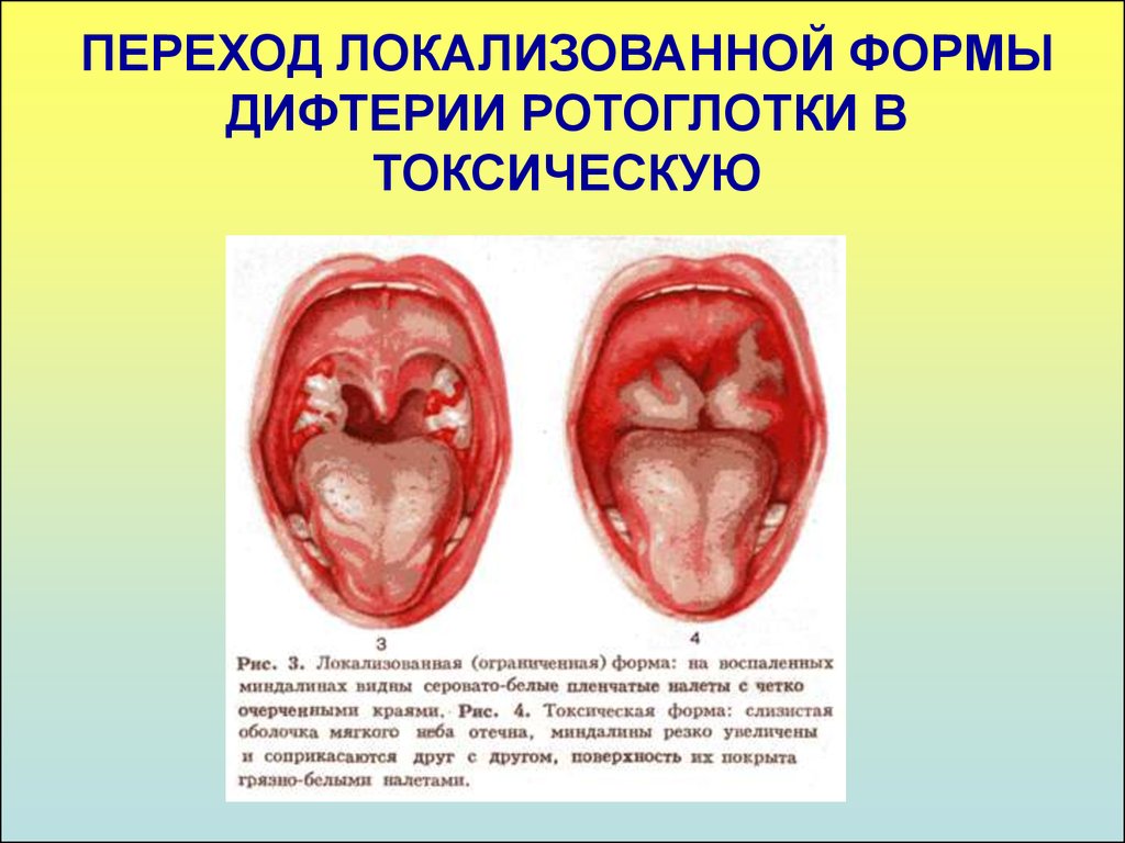 Дифтерия ротоглотки у детей фото