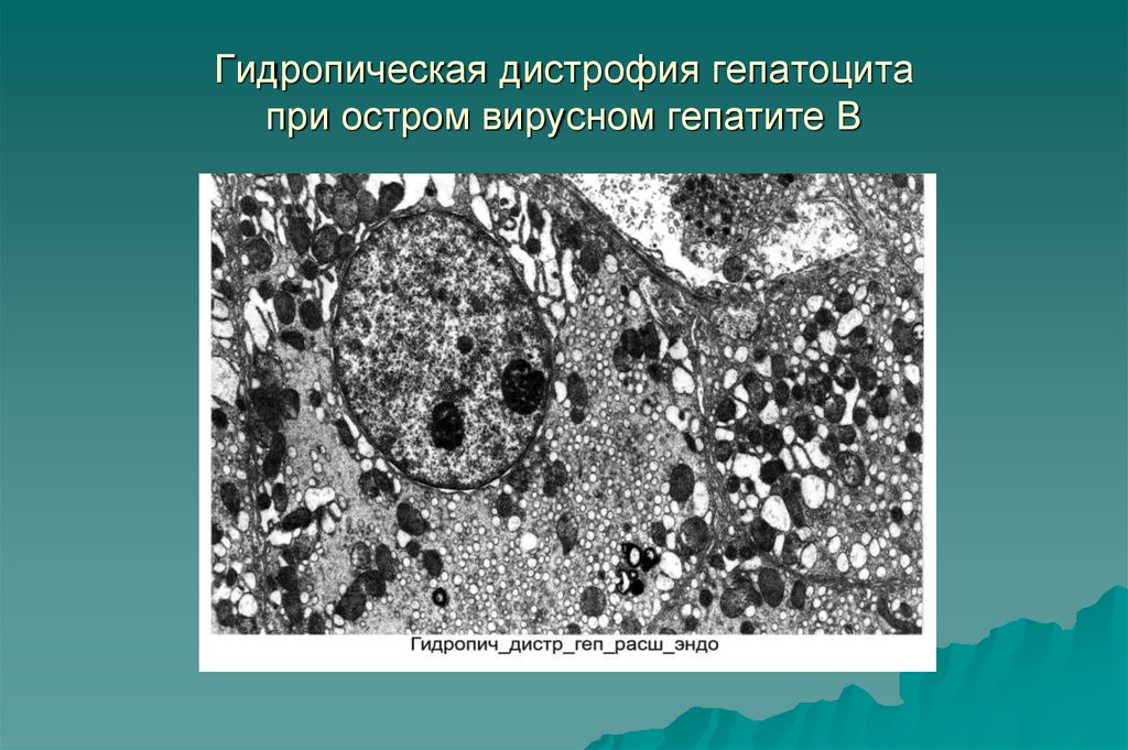 Процесс сопровождающийся накоплением в цитоплазме гепатоцитов. Гидропическая дистрофия гепатоцитов. Гидропическая вакуольная дистрофия. Гигроскопическая дистрофия. Баллонная дистрофия гепатоцитов.