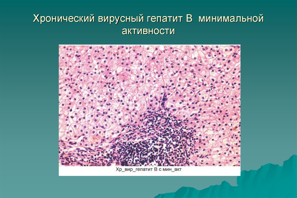 Хронический вирусный гепатит В минимальной активности