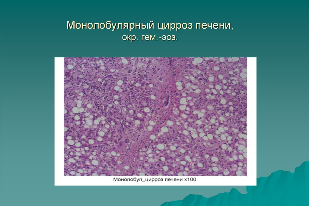 Лечение дистрофии печени. Массивный прогрессирующий некроз печени макро. Центролобулярные некрозы печени. Центролобулярные некрозы печени гистология. Цирроз печени макропрепарат печени.