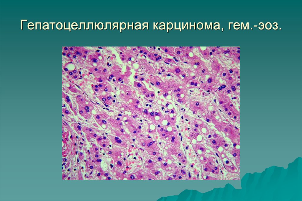 Аденокарцинома печени 4 стадия. Карцинома печени гистология. Гепатоцеллюлярная карцинома печени гистология. Фиброламеллярная карцинома. Гепатоцеллюлярная аденома гистология.