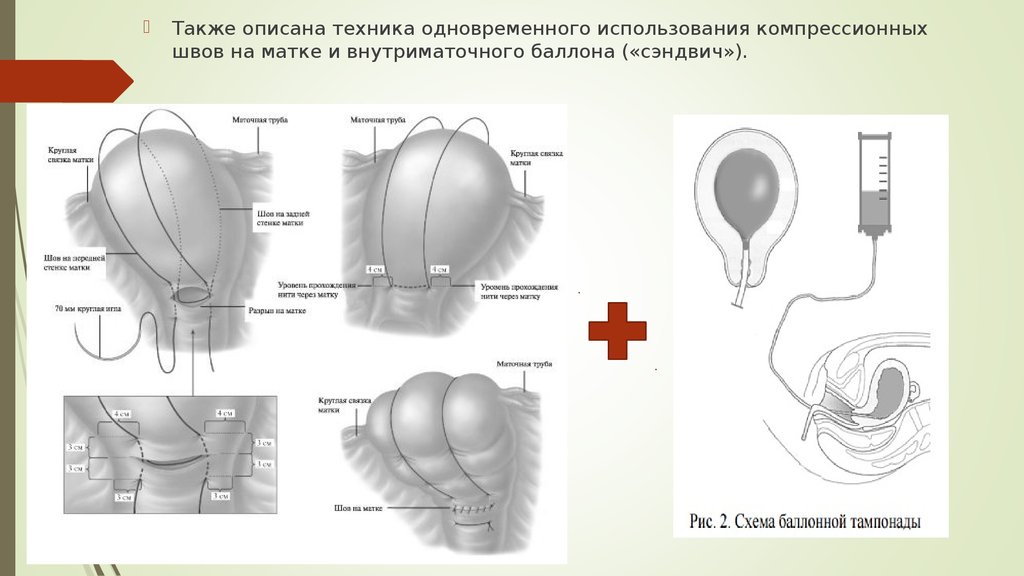 Баллонная тампонада матки презентация