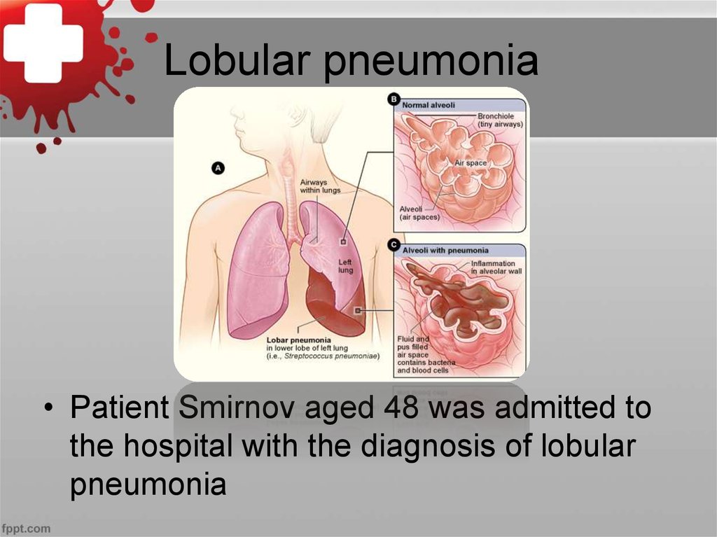 Пневмония презентация внутренние болезни
