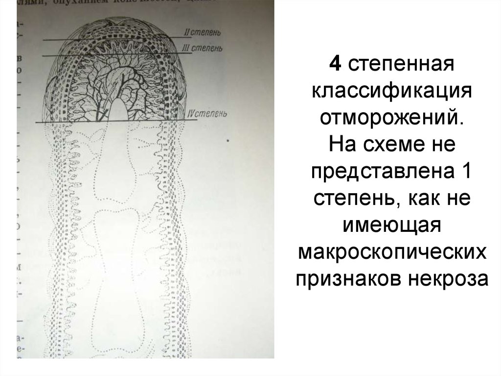 Патогенез отморожения схема