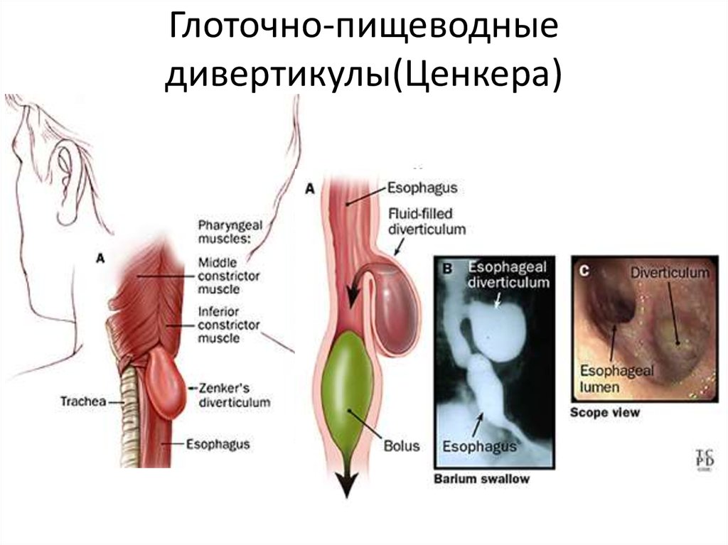 Диагностика дивертикула пищевода