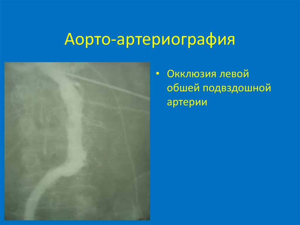 Острая артериальная ишемия. Аортоартериография нижних конечностей. Окклюзия левой подвздошной артерии. Острая артериальная непроходимость.