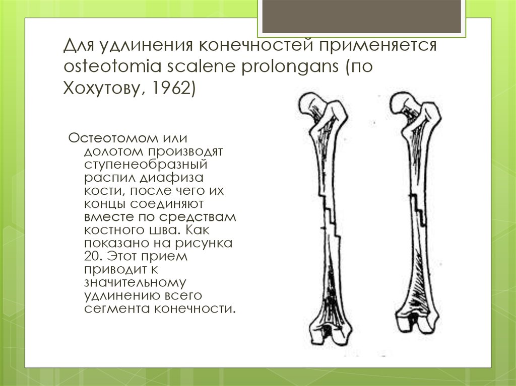 Удлиненная кость. Техника удлинения трубчатых костей. Смещении при переломах трубчатых костей. Удлинение бедренной кости. Удлиненные конечности.