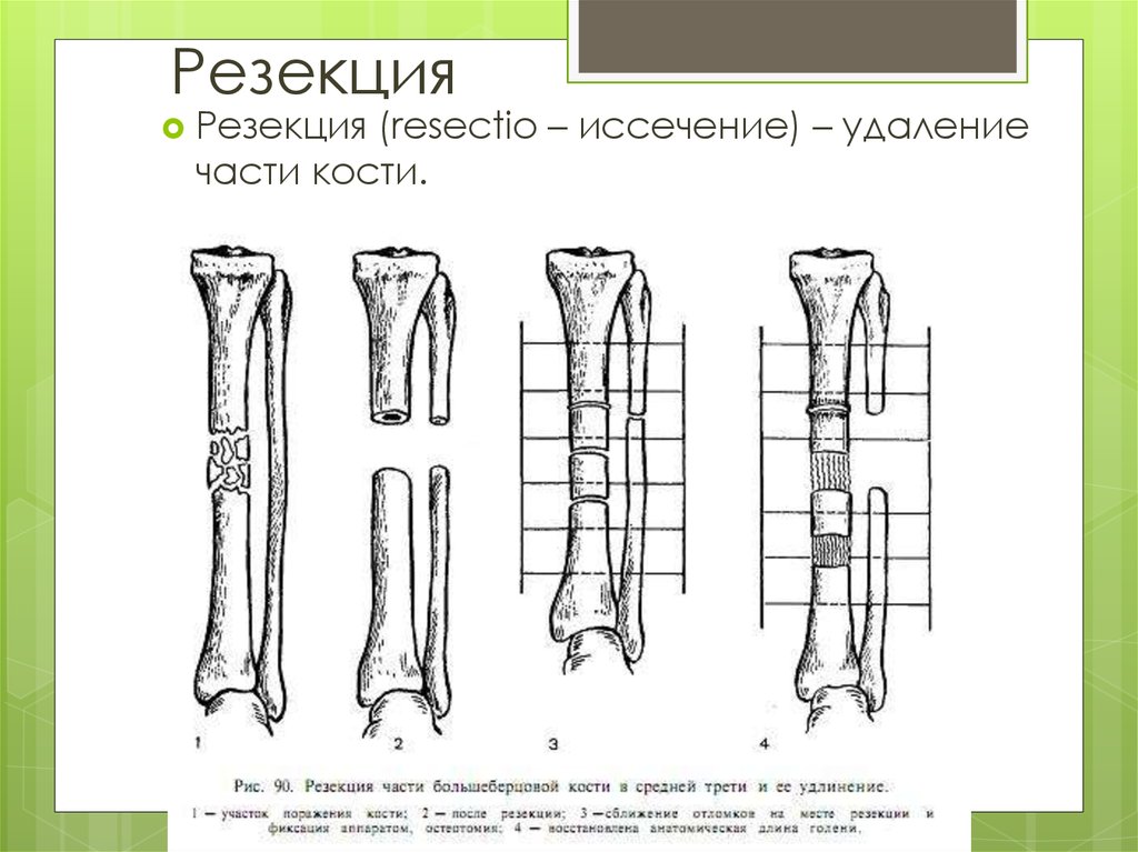 Удалить кости. Чрескостный остеосинтез большеберцовой кости. Костная пластика бедренной кости. Чрезкостный остеосинтез нижней трети большеберцовой кости. Поднадкостничная резекция кости.