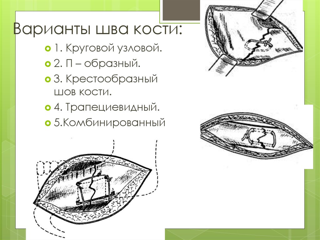 Шов кости. Трапециевидный шов. Трапециевидный костный шов. Трапециевидный шов на кость.