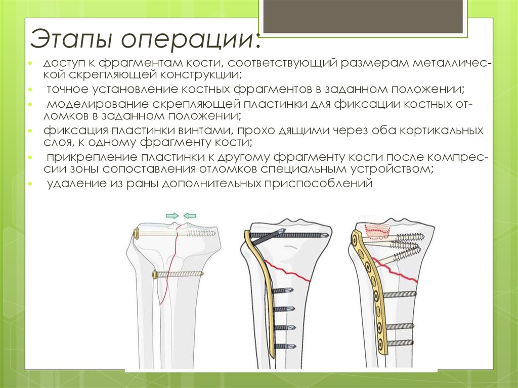 Стадии операции. Остеосинтез этапы операции. Этапы остеосинтеза этапы.
