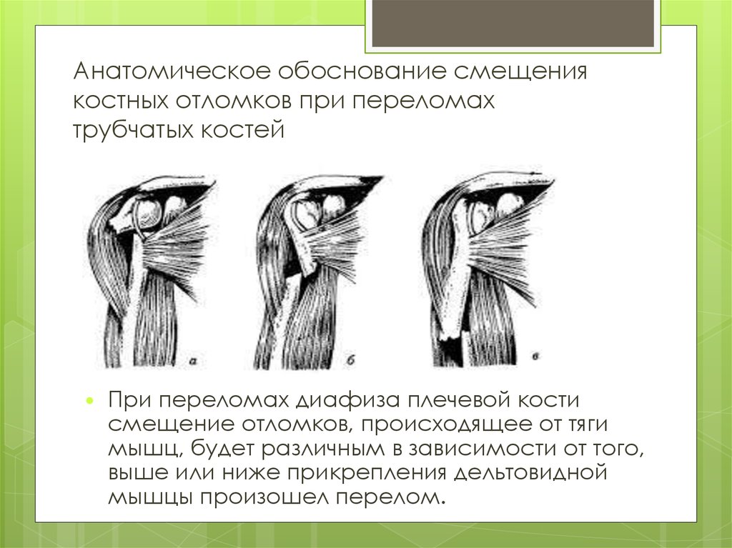 Диафиза плечевой кости. Смещение отломков при переломе диафиза плечевой кости. Переломы диафиза плечевой кости смещения отломков. Переломы диафизп Плеа классфиуация. Перелом диафиза плеча классификация.