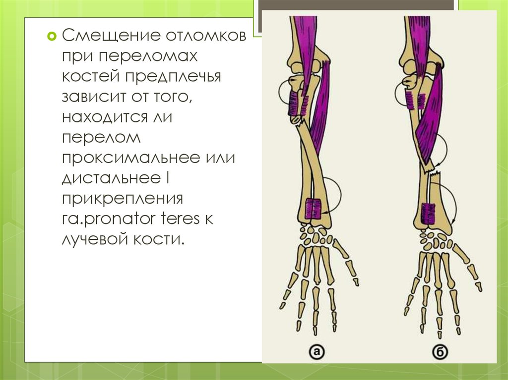 Смещение отломков кости. Смещение костей предплечья при переломах. Смещение отломков при переломе костей предплечья. Перелом диафиза костей предплечья. Смещение отломков при переломе.