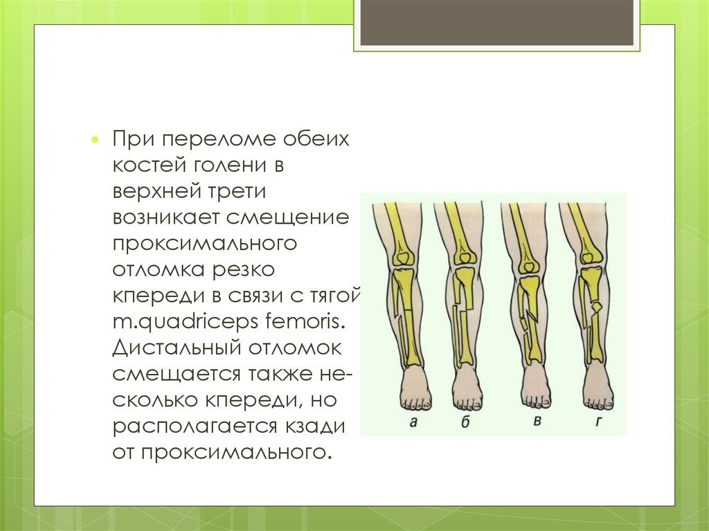 При переломах каких костей. Дистальный отломок при переломе. Смещение отломков при переломе костей голени. Закрытый перелом средней трети правой голени. Переломы костей голени в верхней, средней, нижней трети.
