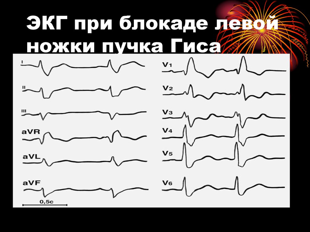 Блокада левого у сердца. Блокада левого желудочка на ЭКГ. ЭКГ блокада левого желудочка сердца. Блокада желудочков на ЭКГ. Блокада ЛНПГ на ЭКГ.