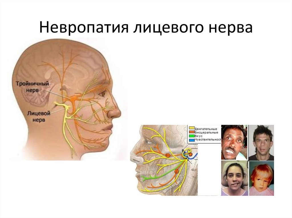Поврежден лицевой нерв. Невропатия тройничного нерва анатомия. Невропатия (неврит) лицевого нерва.. Неврит невропатия тройничного нерва. Лицевой нерв и тройничный нерв.
