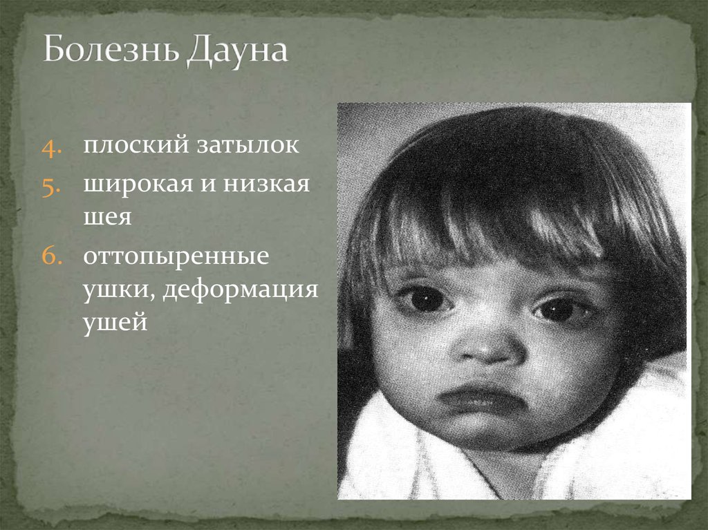 Болезнь дауна