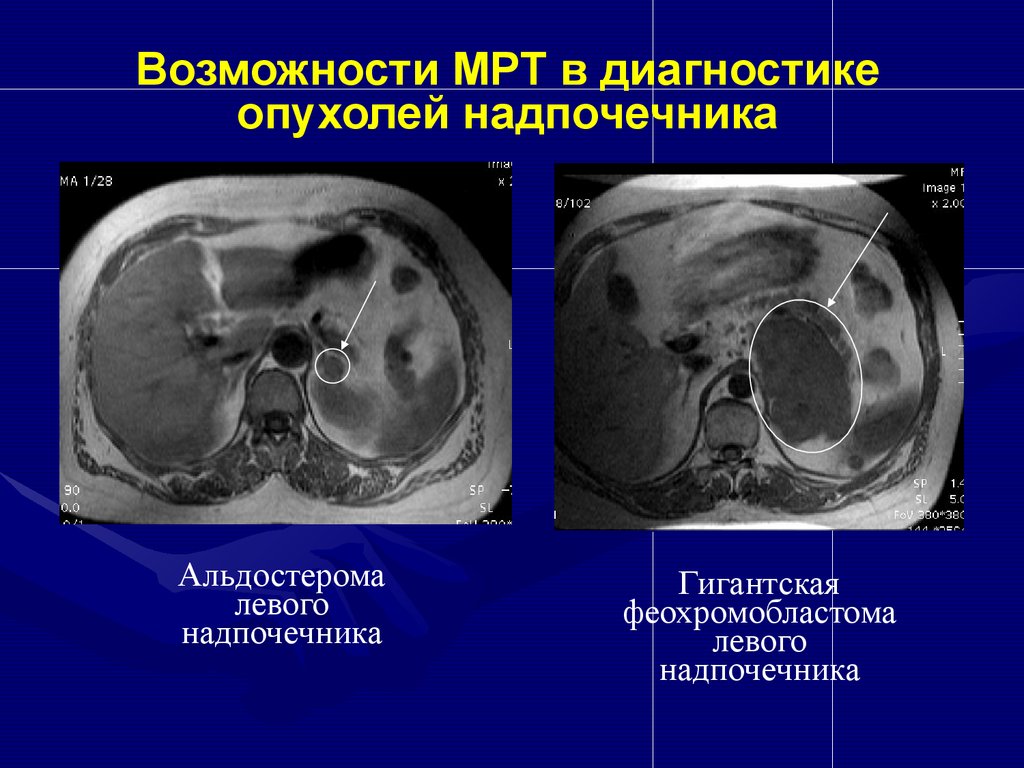 Опухоль надпочечников у мужчин