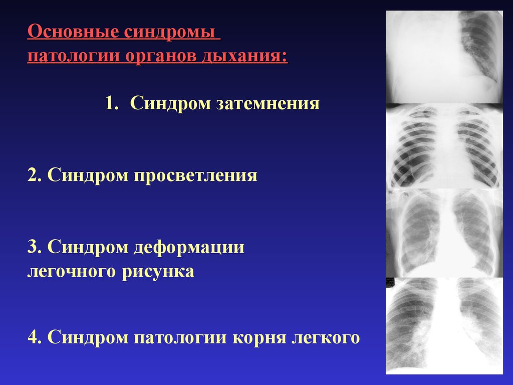 Синдром патология. Синдром патологии легочного рисунка рентген. Патология органов дыхания. Синдромы патологии органов дыхания. Указать основные рентгенологические синдромы патологии легких.