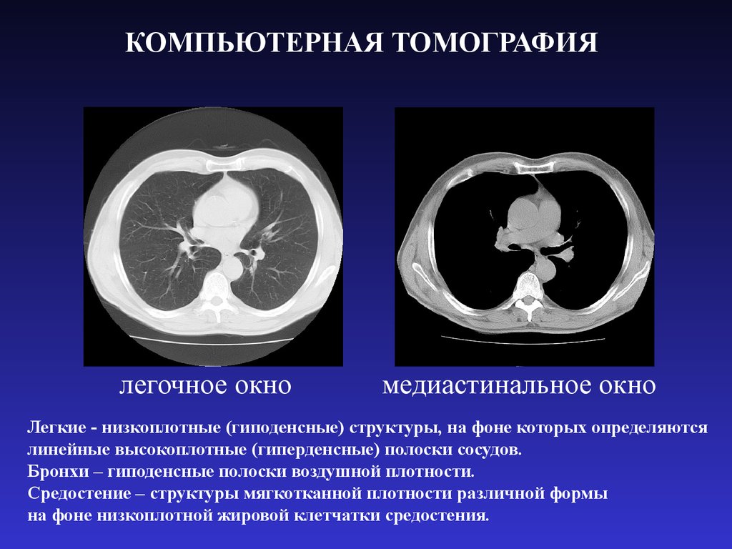 Гиперденсные структуры на кт изображениях