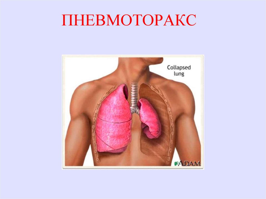 Пневмоторакс картинки для презентации