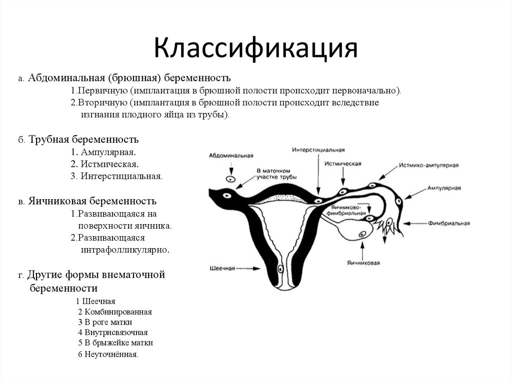 Забеременела без труб естественным путем. Трубная беременность классификация. Внематочная Трубная ампулярная беременность. Внематочная беременность схема. Истмическая внематочная беременность.