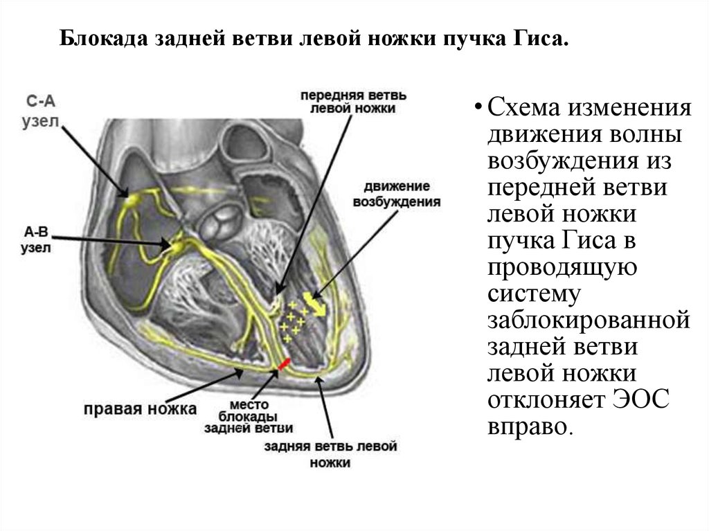 Блокада левой передней ветви. Задняя ветвь левой ножки пучка Гиса. Блокада задней ветви левой ножки пучка Гиса на ЭКГ. Блокада срединной ветви левой ножки пучка. ЭКГ при блокаде задней ветви левой ножки пучка Гиса.