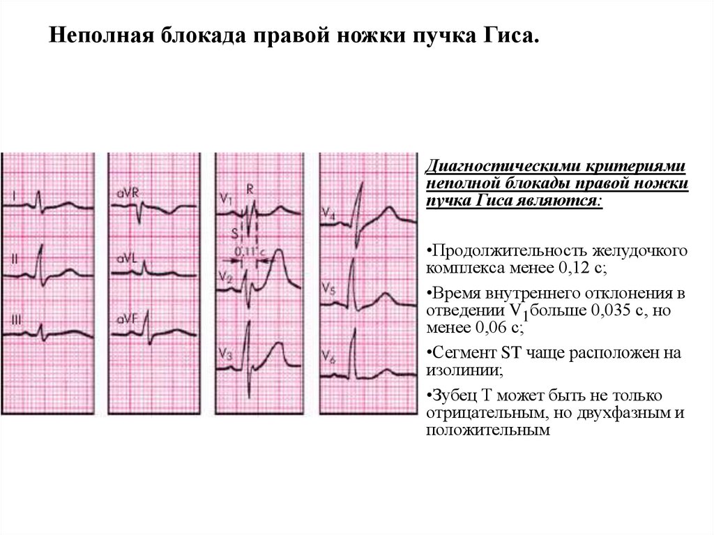 Блокада пучка гиса на экг. ЭКГ признаки блокады ножек пучка Гиса. Блокада правой ножек пучка Гиса на ЭКГ. Блокада правой ножки пучка Гиса на ЭКГ что это на ЭКГ. ЭКГ критерии блокады пучка Гиса.