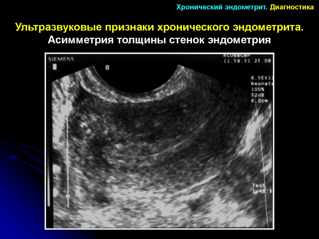 Эндометрия лечение. Диагностика хронического эндометрита. Послеродовый эндометрит УЗИ. Хронический эндометрит УЗИ.