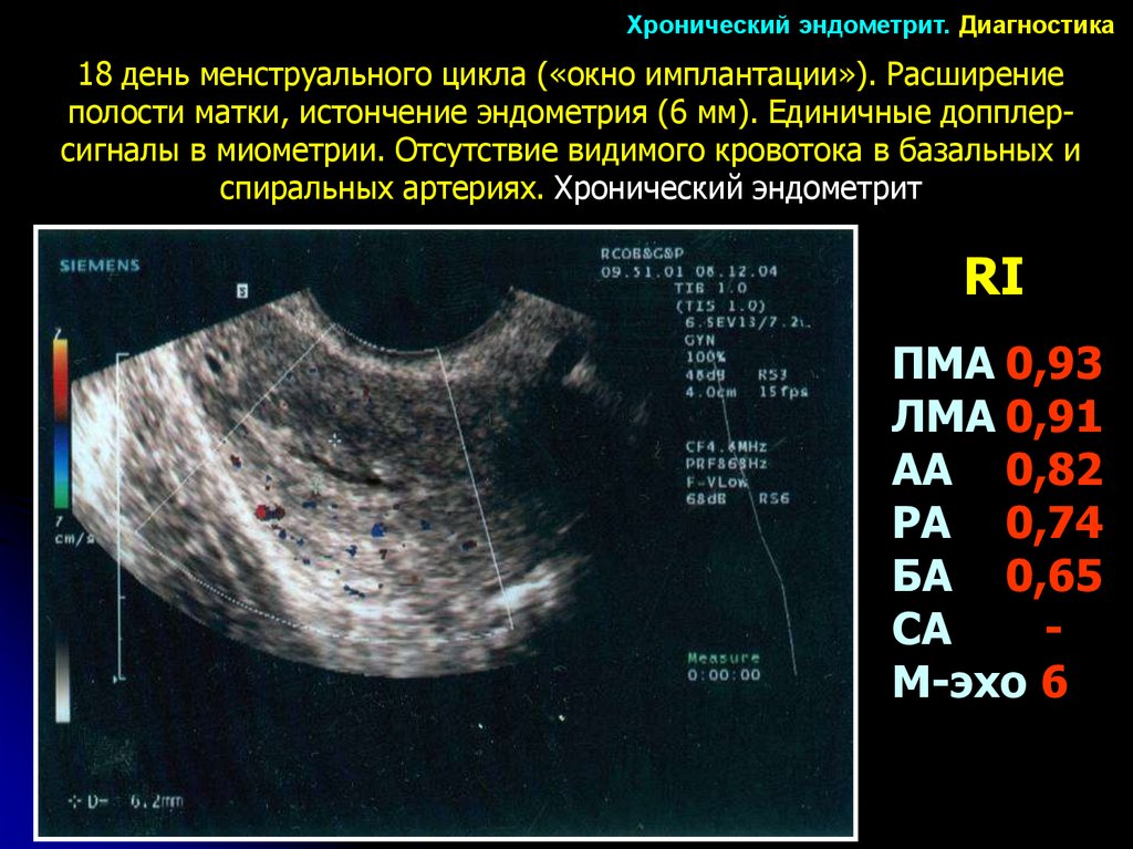 Расширение полости матки. Эндометрий в полости матки норма на УЗИ. Эндометрий на 5 день цикла по УЗИ. Норма слоя эндометрия в матке.