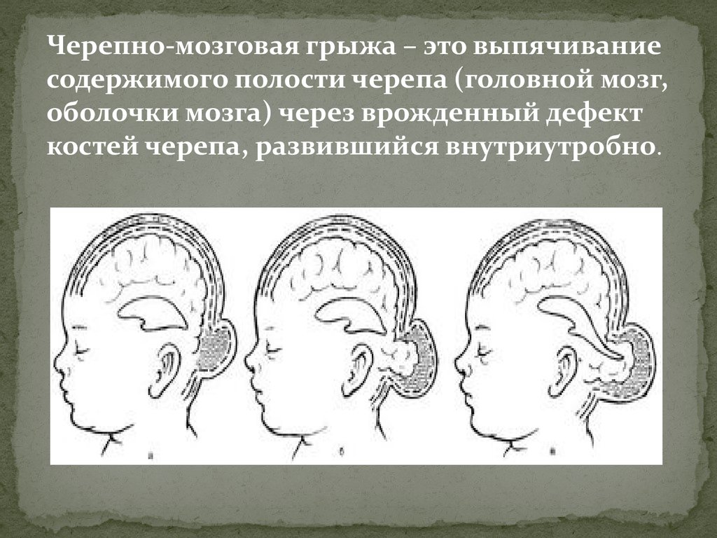 Нарушение развития головного мозга. Аномалии развития головного мозга у детей. Черепномозловые грыжи. Черепно мозговые грыжи у детей.