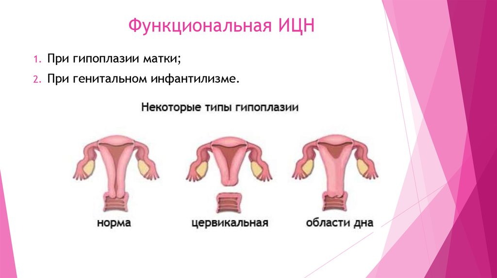 1 матка. Гипоплазия матки 1 степени. Степени недоразвития матки.