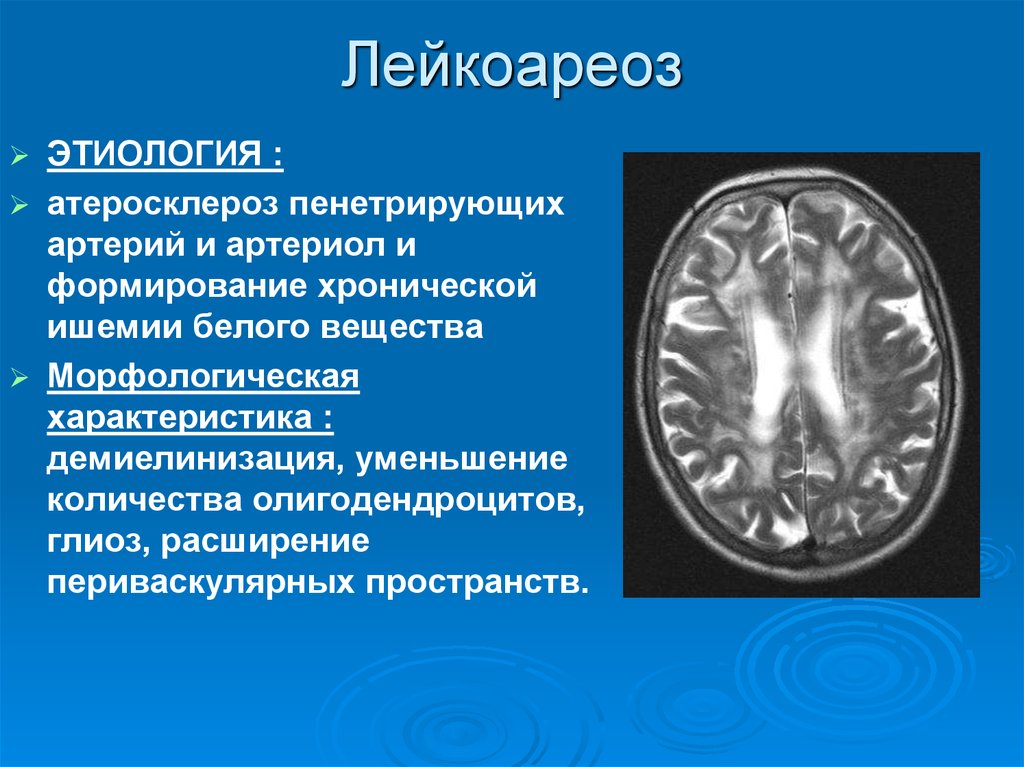 Дисциркуляторные дистрофические изменения. Лейкоэнцефалопатия неврология. Перивентрикулярный лейкоареоз. Кт признаки лейкоареоза головного мозга. Лейкоареоз кт протокол.