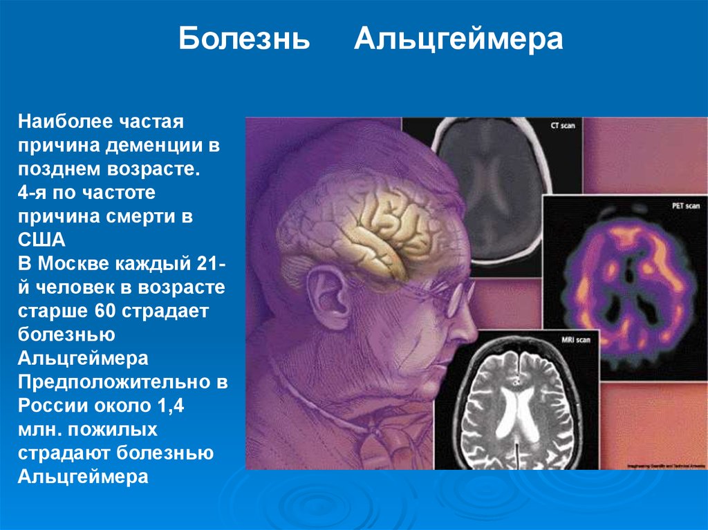 Деменция головы. Болезнь Альцгеймера. Деменция и Альцгеймер. Болезнь Альцгеймера презентация. Клинические проявления болезни Альцгеймера.