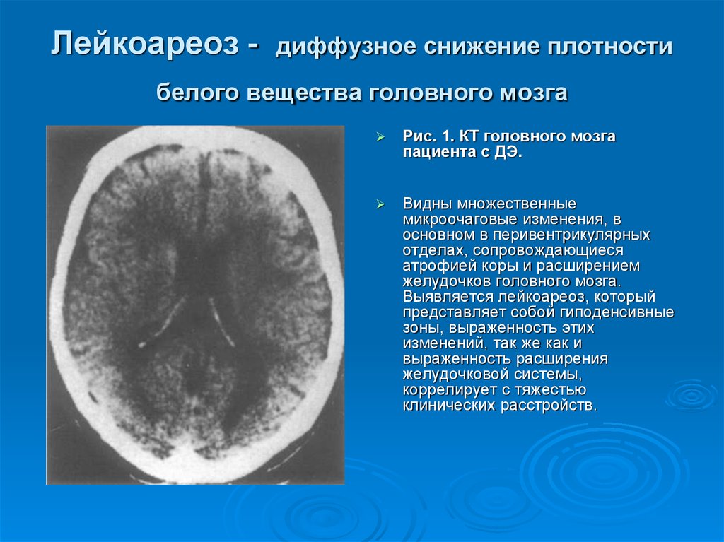 Умеренная атрофия мозга