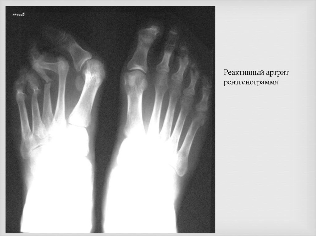 Реактивные артриты презентация