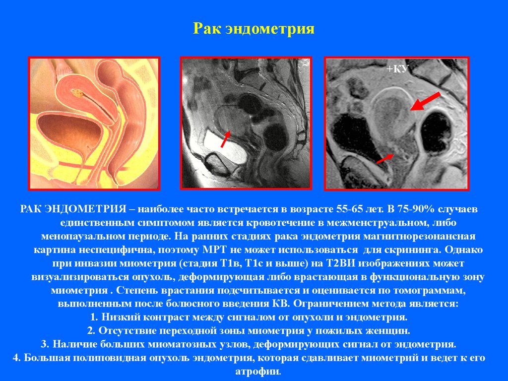 Новообразования эндометрия. Опухоль эндометрия мрт. Образования тела матки мрт. Патология эндометрия мрт.