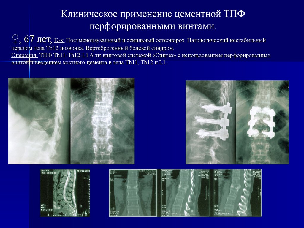 Компрессионный перелом тела 1 1. Компрессионный перелом позвоночника th12 l3. Компрессионный перелом l1 th12. Патологические переломы позвонков при остеопорозе. Патологический перелом тела th12.